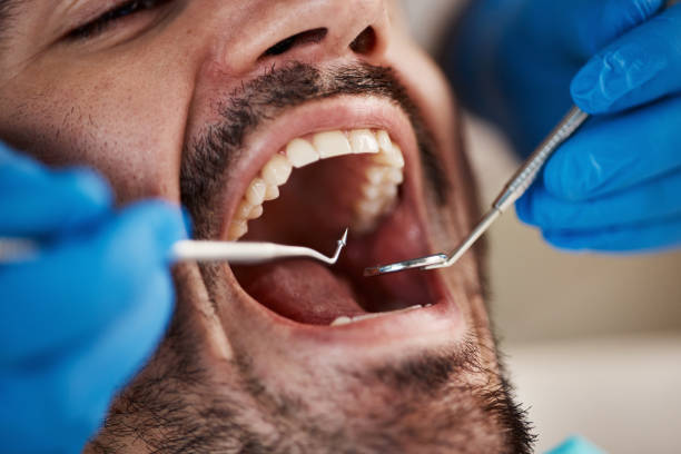 Best Emergency Dentist for Lost Fillings or Crowns in Fort Scott, KS